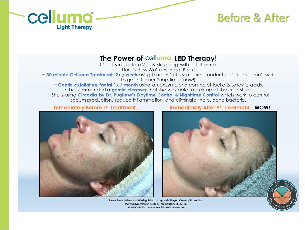 Before and After Image: Microneedling - left-side