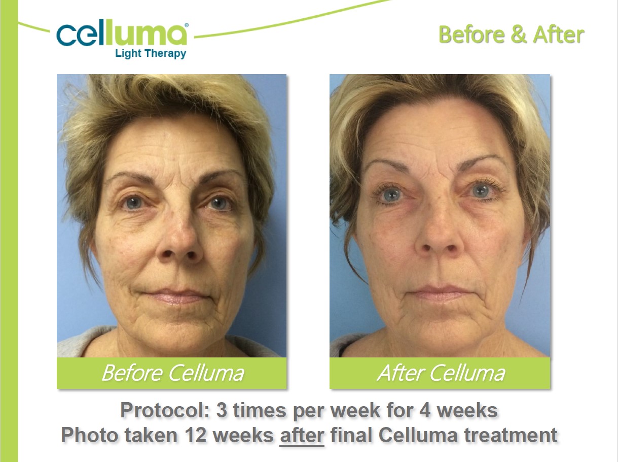 Before and After Image: Microneedling - front
