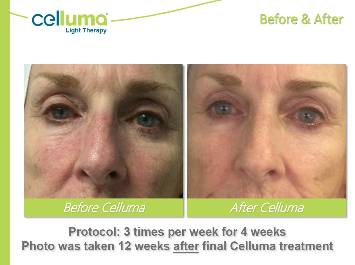 Before and After Image: Microneedling - front