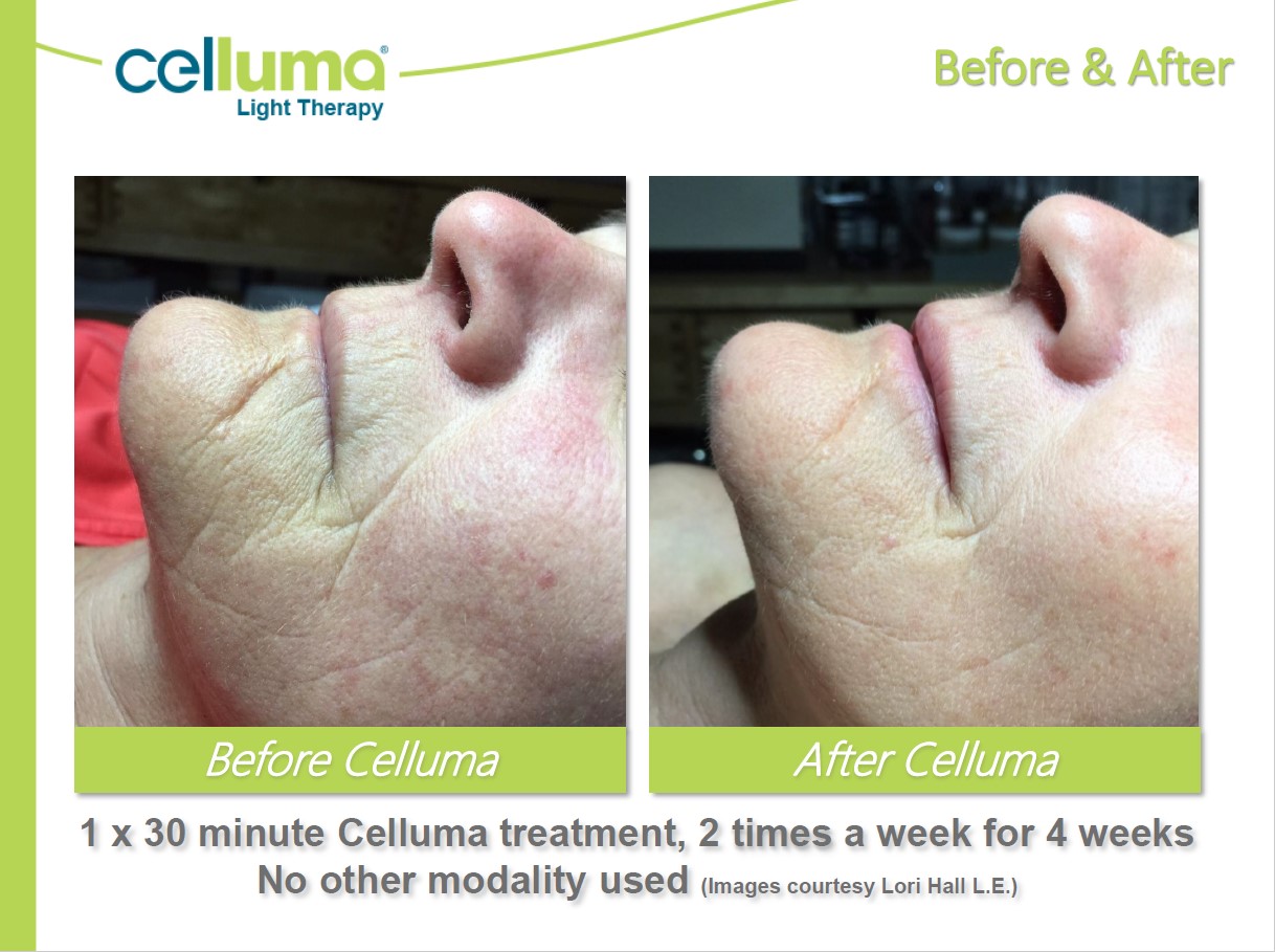Before and After Image: Microneedling - left-side