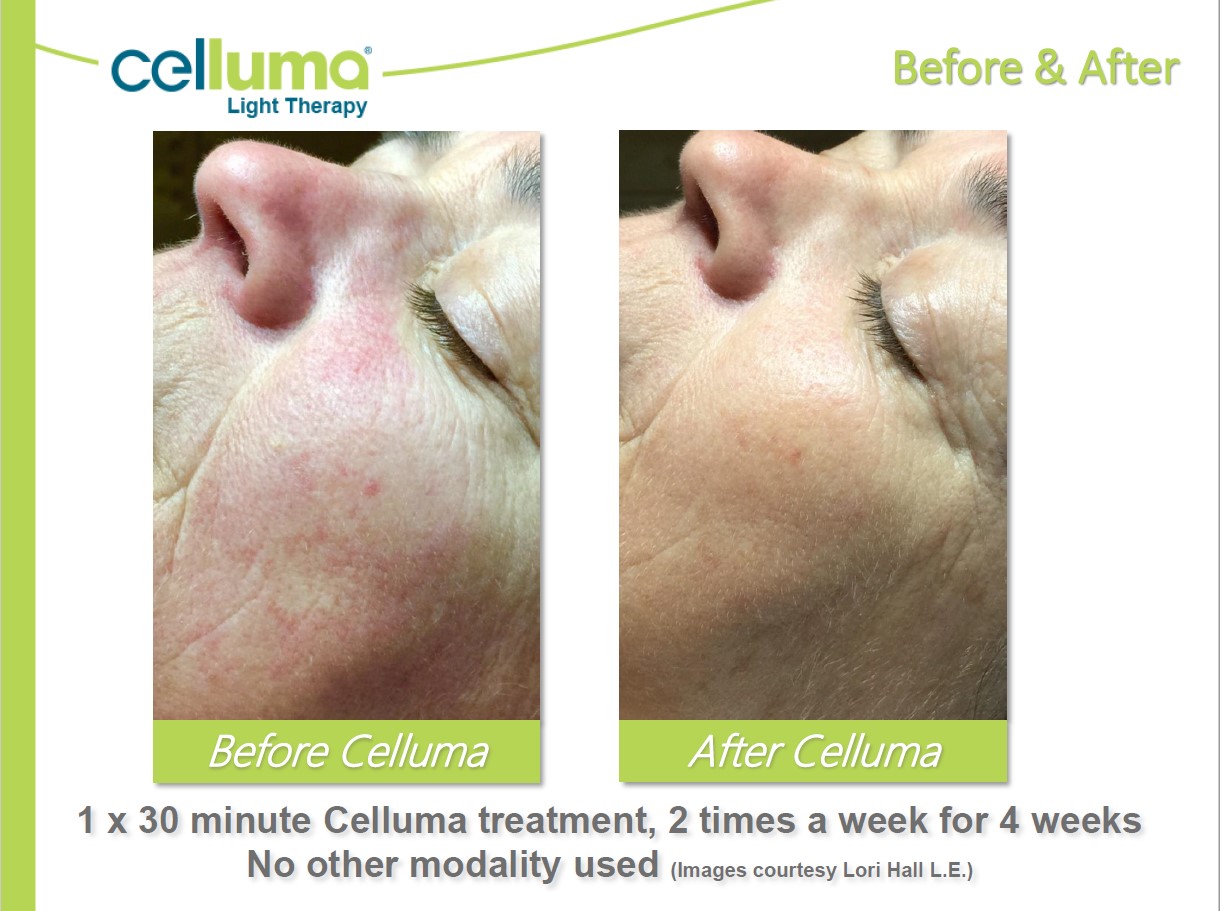 Before and After Image: Microneedling - left-side