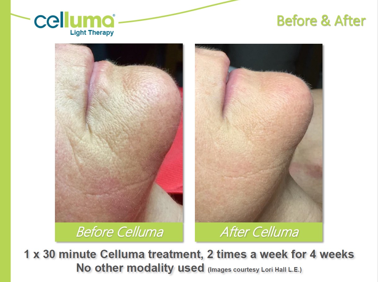 Before and After Image: Microneedling - right-front-oblique