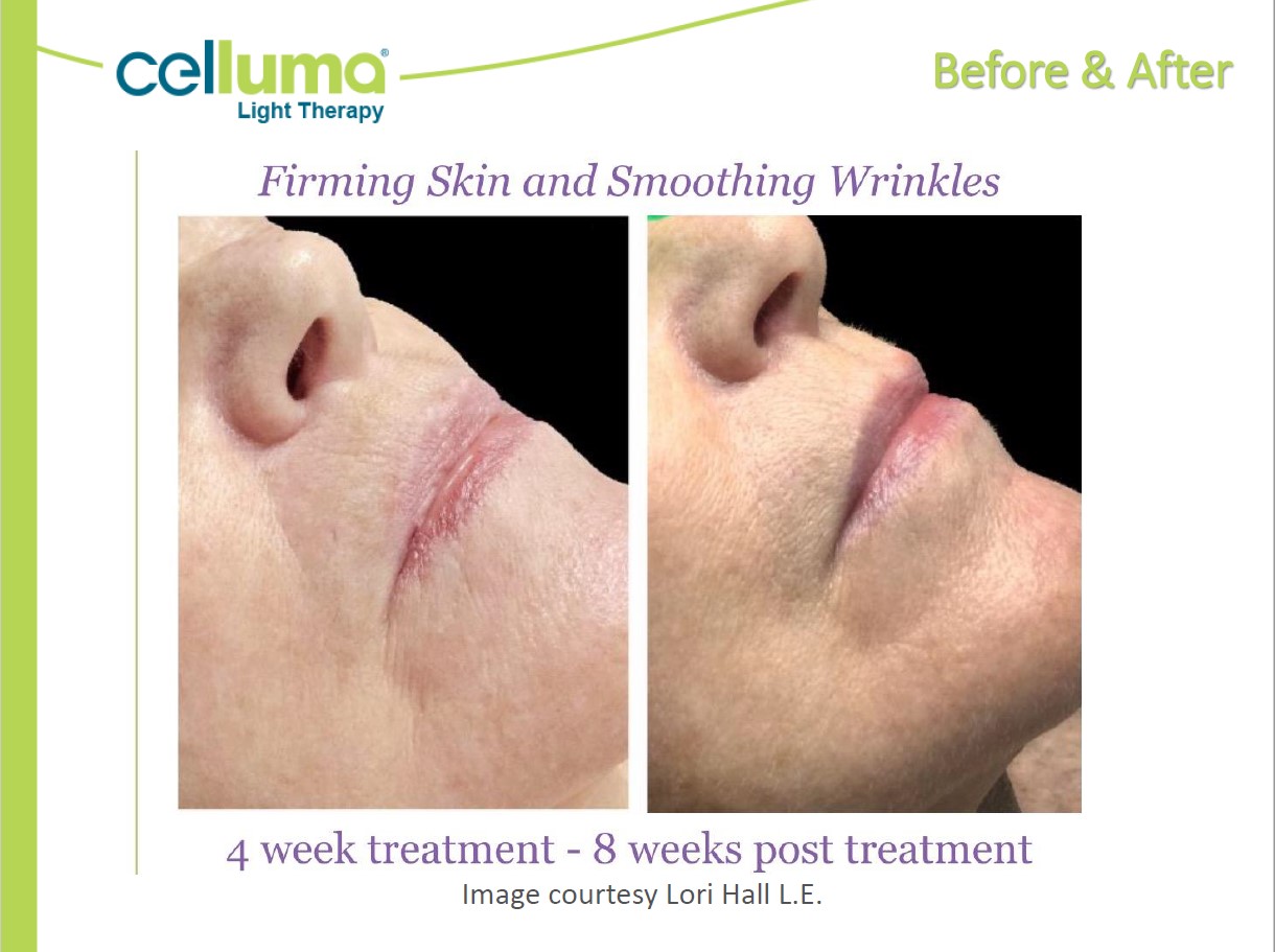 Before and After Image: Microneedling - right-front-oblique