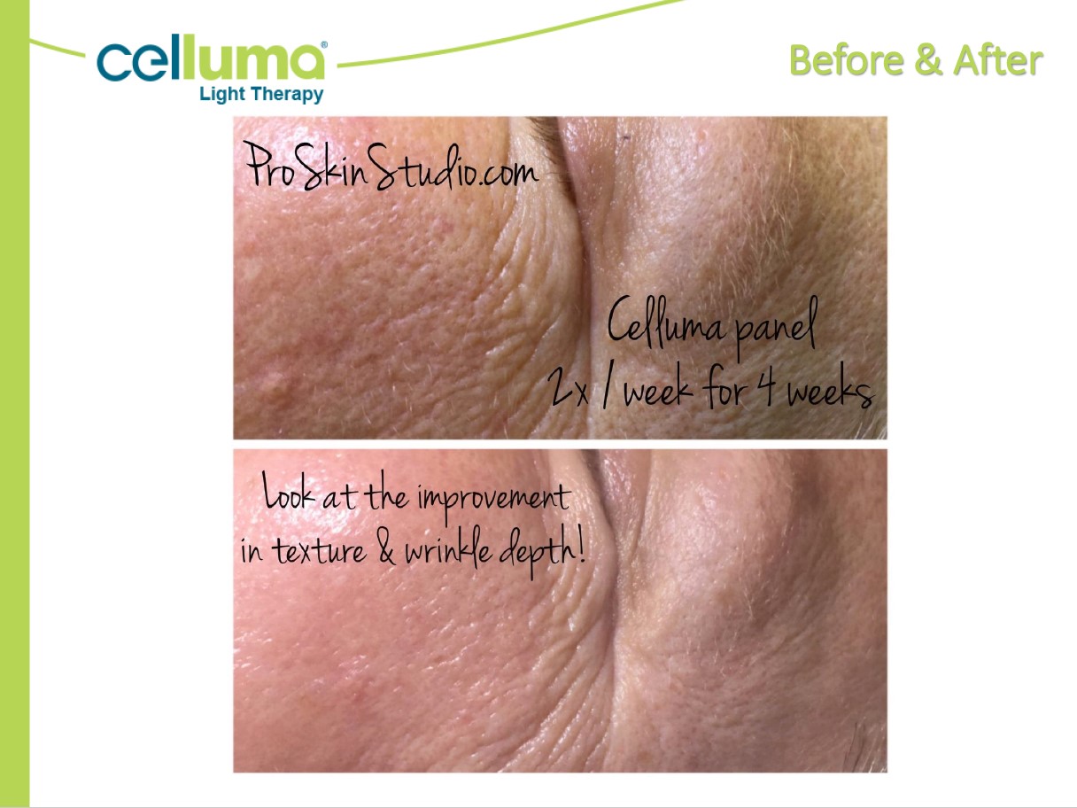Before and After Image: Microneedling - left-side
