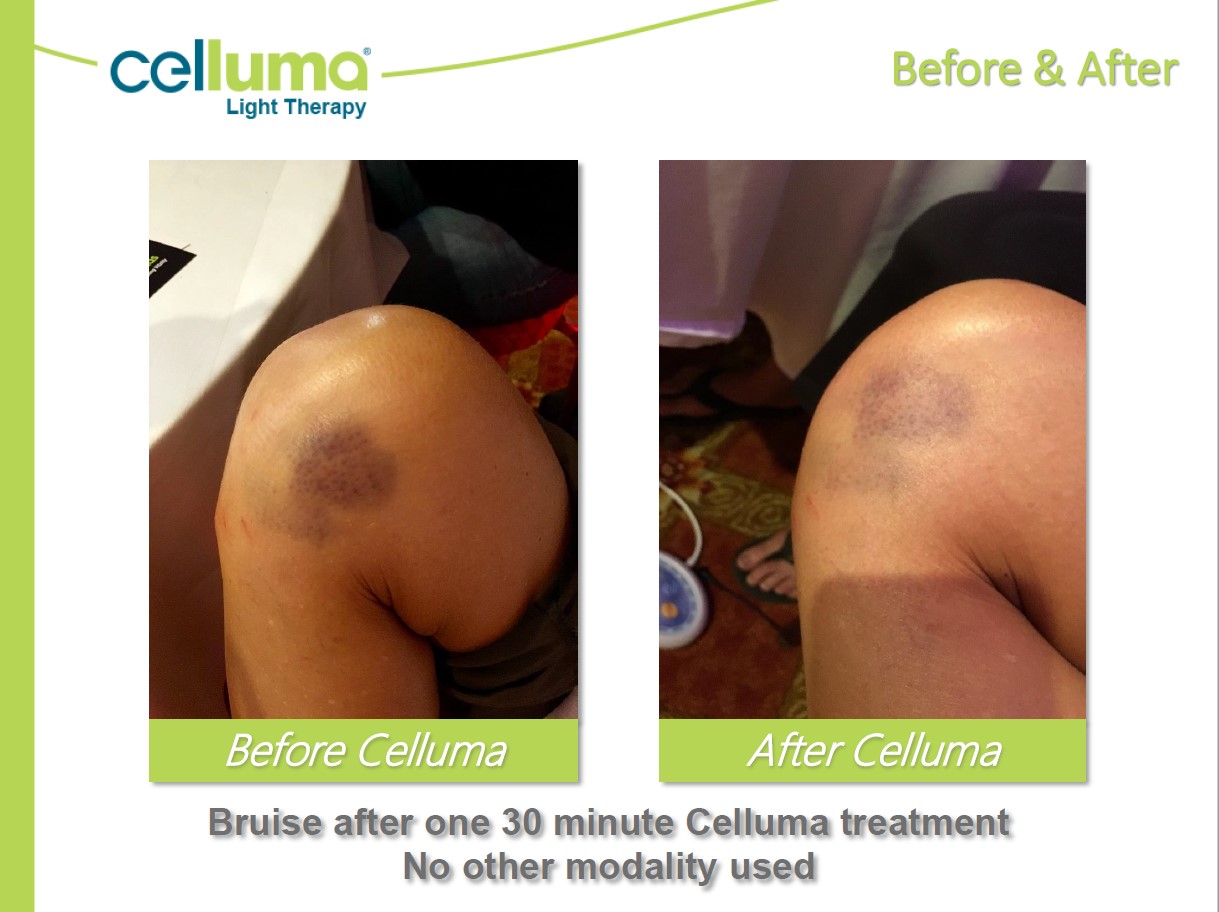 Before and After Image: Microneedling - front