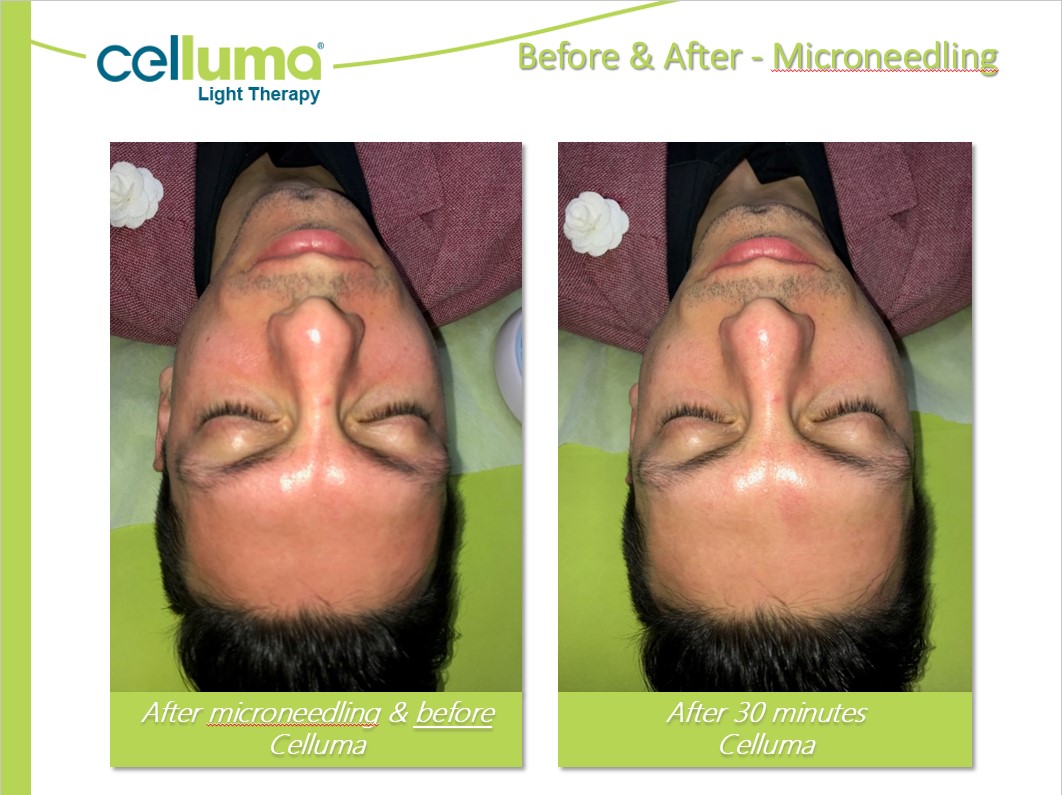 Before and After Image: Microneedling - front