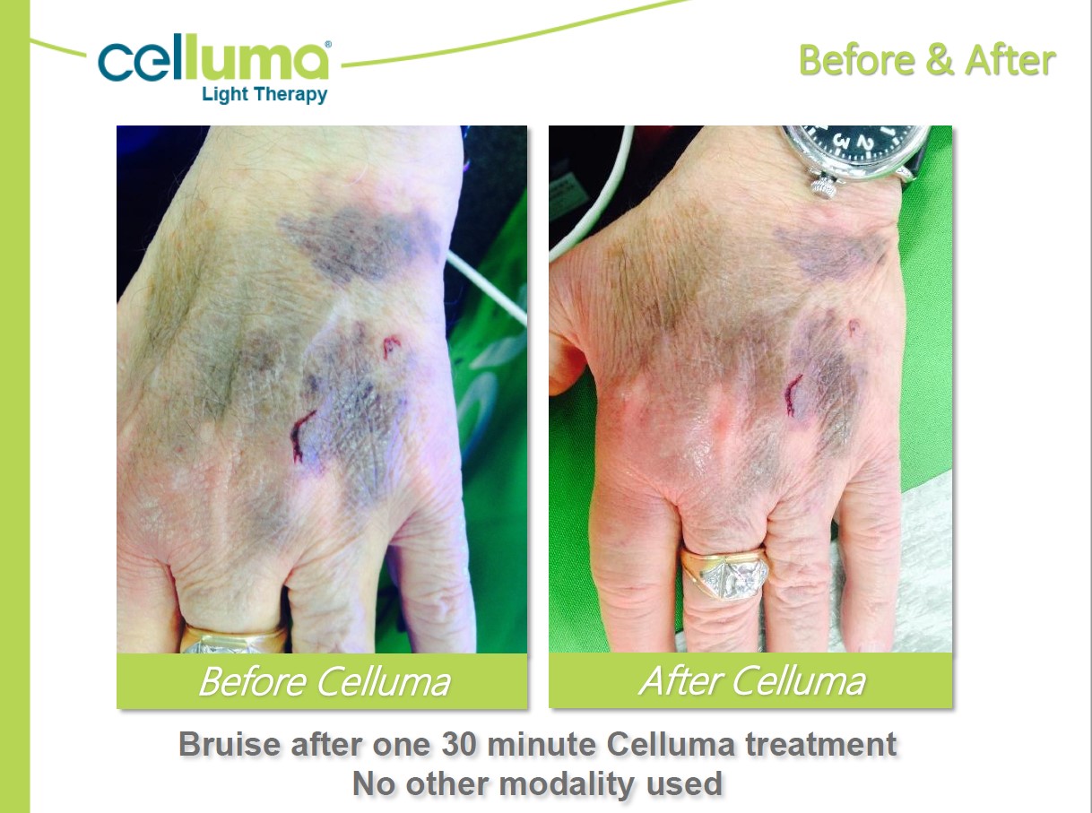Before and After Image: Microneedling - front