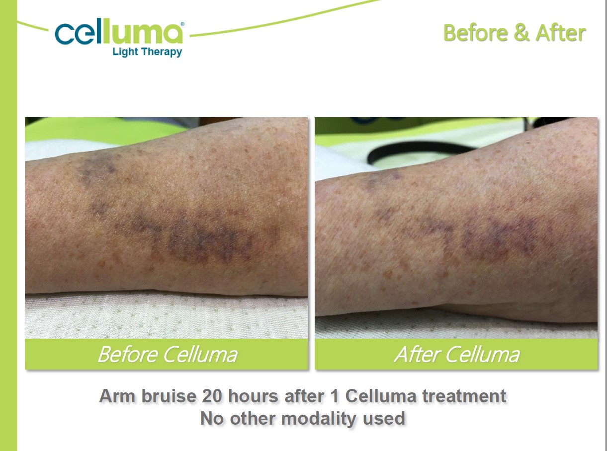 Before and After Image: Microneedling - front