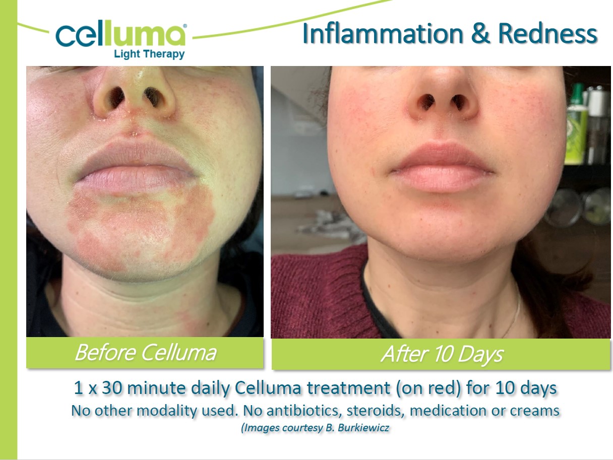 Before and After Image: Microneedling - front