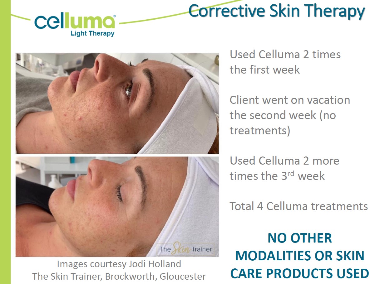 Before and After Image: Microneedling - left-side