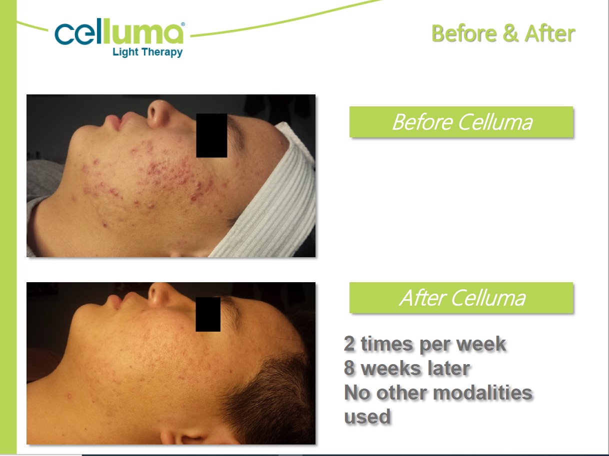 Before and After Image: Microneedling - left-side