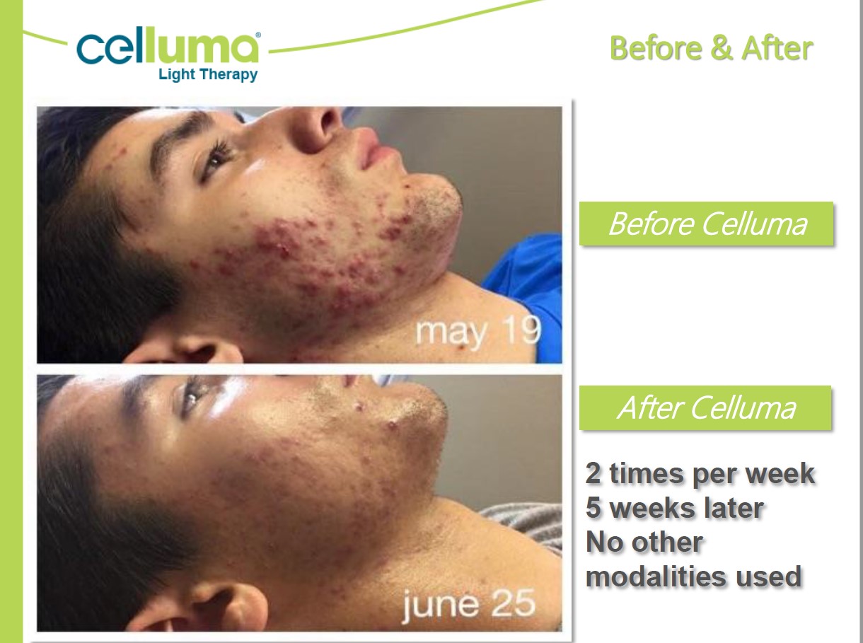 Before and After Image: Microneedling - right-side