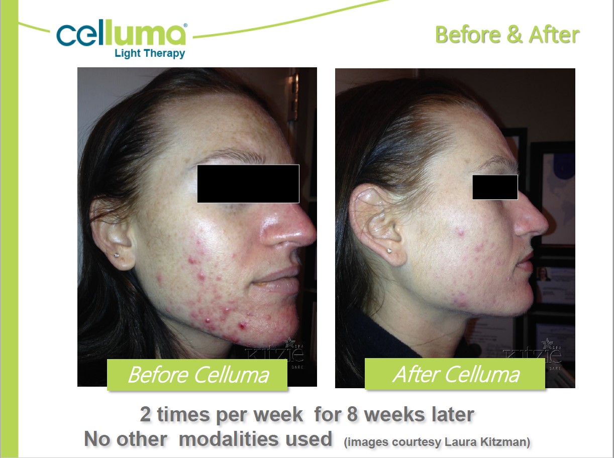 Before and After Image: Microneedling - right-front-oblique