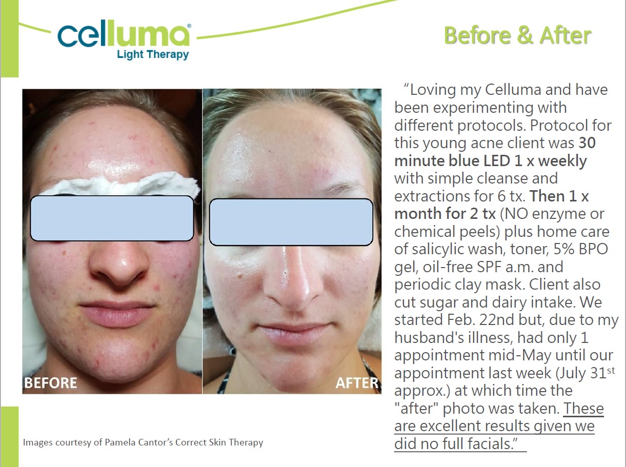 Before and After Image: Microneedling - front