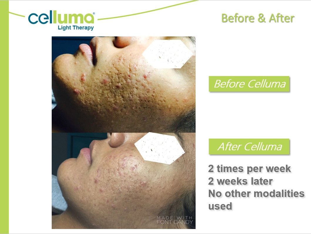 Before and After Image: Microneedling - left-side