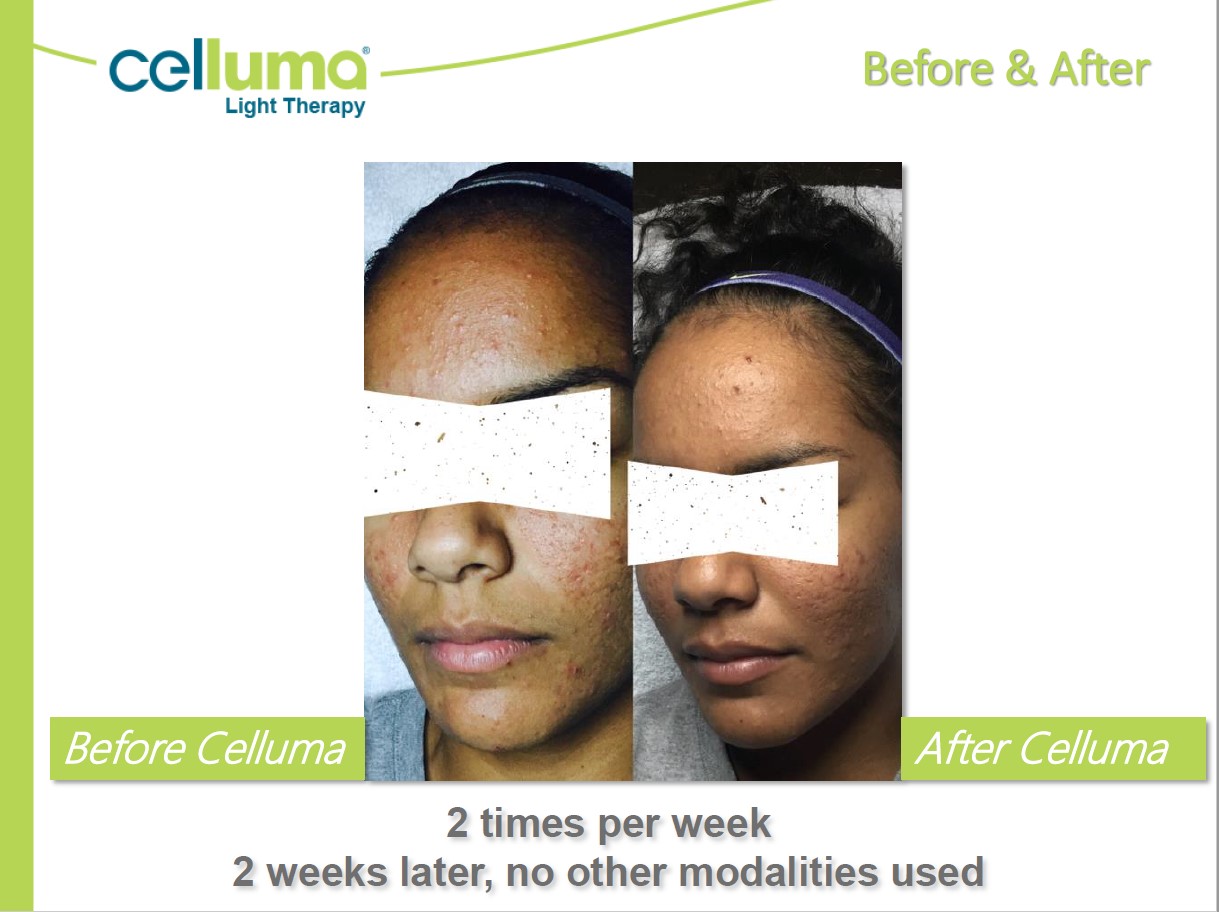 Before and After Image: Microneedling - left-front-oblique